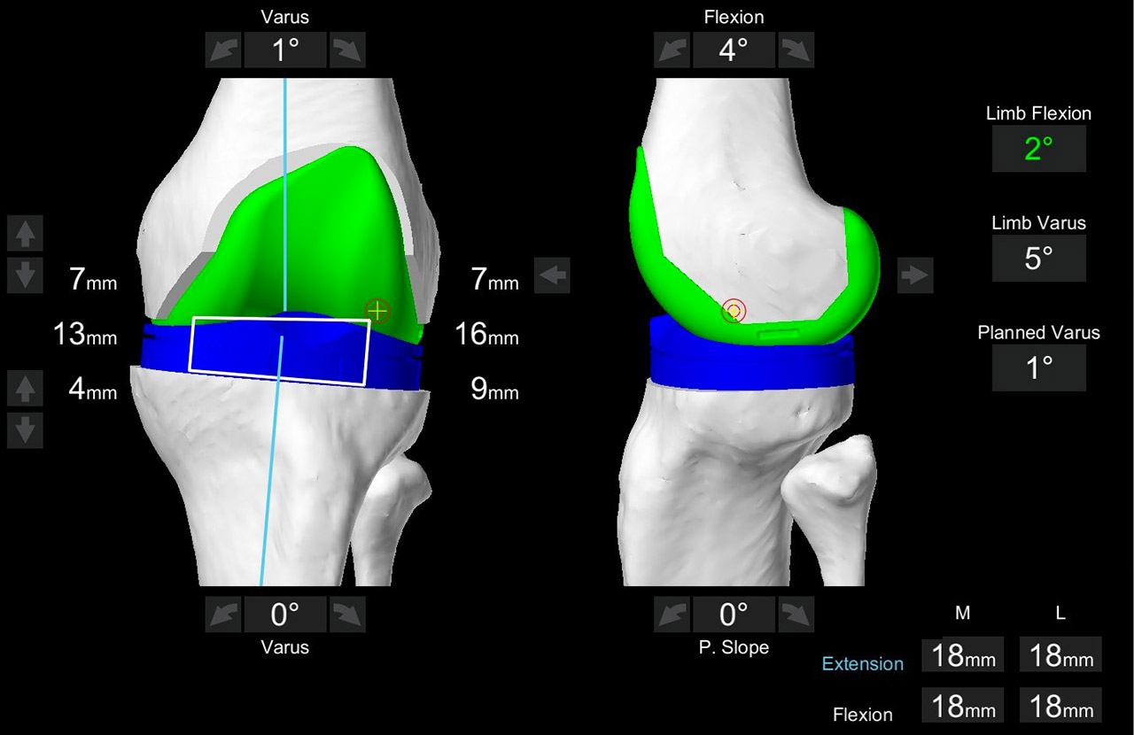 FAQ - CHROMA Marseille chirurgie orthopédique robotique Marseille