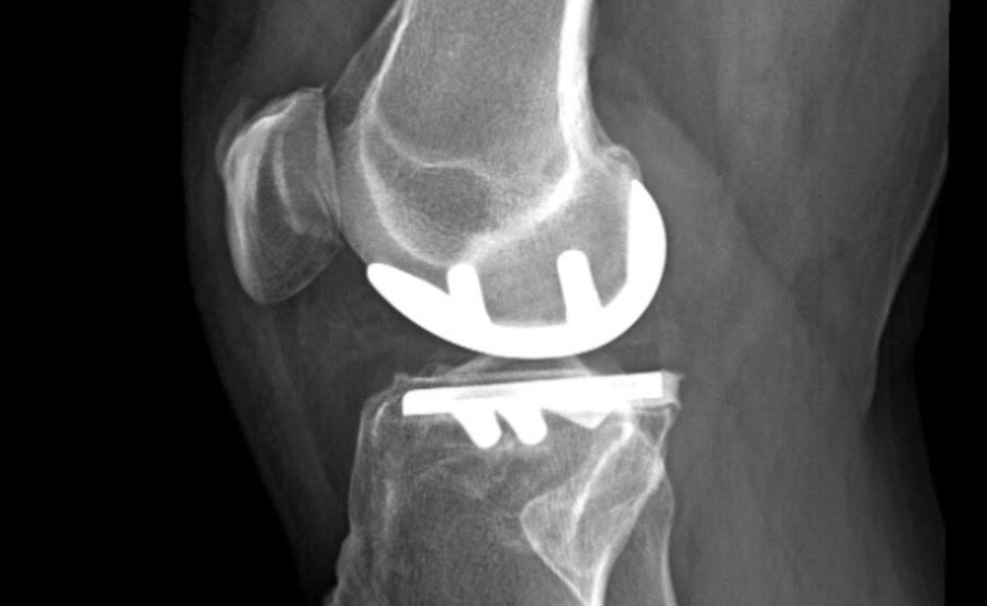 Grâce à l'intervention d'un chirurgien orthopédiste à Marseille, cette patiente pourra retrouver une vie normale.