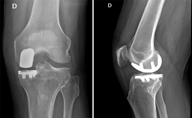 Le protocole orthopédique Mako inclut une radiographie de contrôle. Ici, radiographie de contrôle à un an d'une prothèse unicompartimentale médiale.