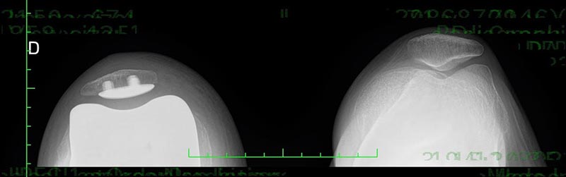 Prothèse totale de genou réalisée avec le Robot Mako (en vue axiale).